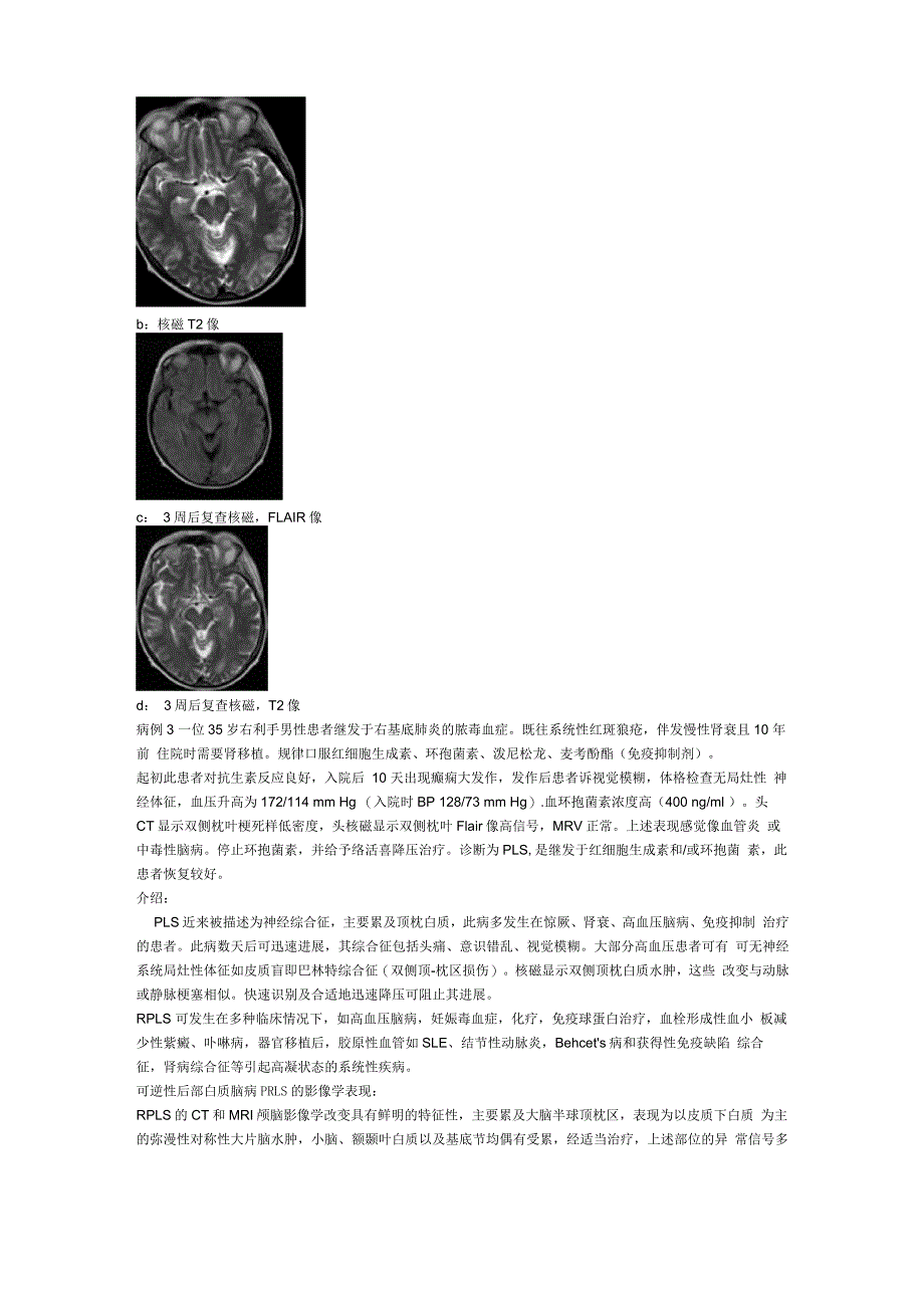 后循环白质脑病综合征_第2页