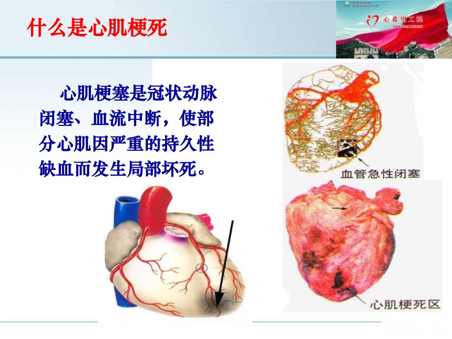 急性心肌梗死的居家救护和预防侯耀文没有心脏病史课件_第3页