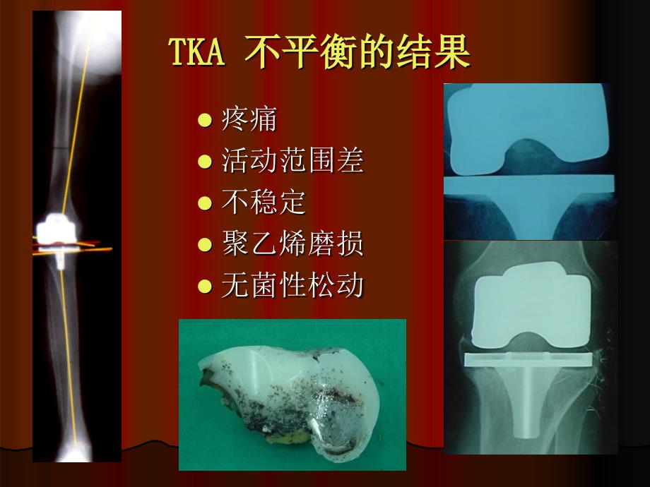 TKA中软组织平衡的原则-PPT文档课件_第2页