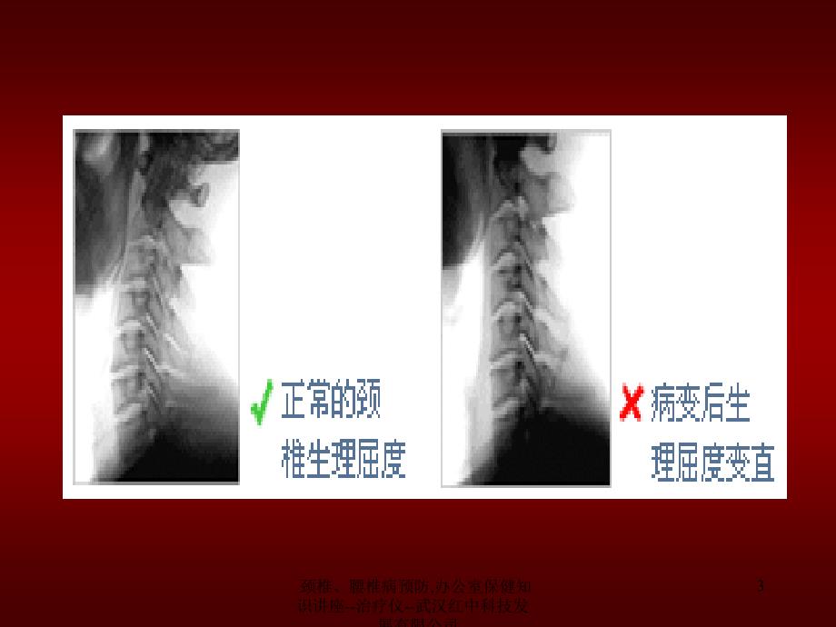 颈椎腰椎病预防办公室保健知识讲座治疗仪武汉红中科技发展有限公司课件_第3页