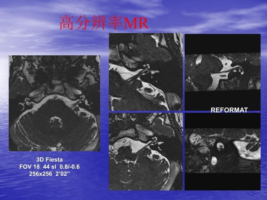 头颈部肿瘤影像诊断与鉴别梁晨阳_第5页