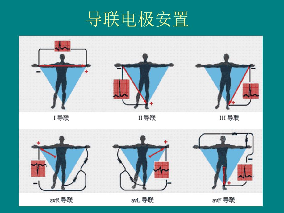 冠心病的心电图表现_第2页