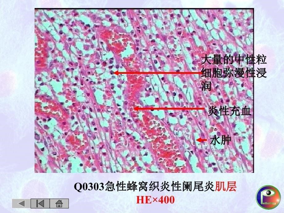 病理学教学资料：第四章 炎症_第5页