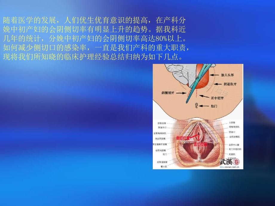 会阴侧切口感染课件_第4页