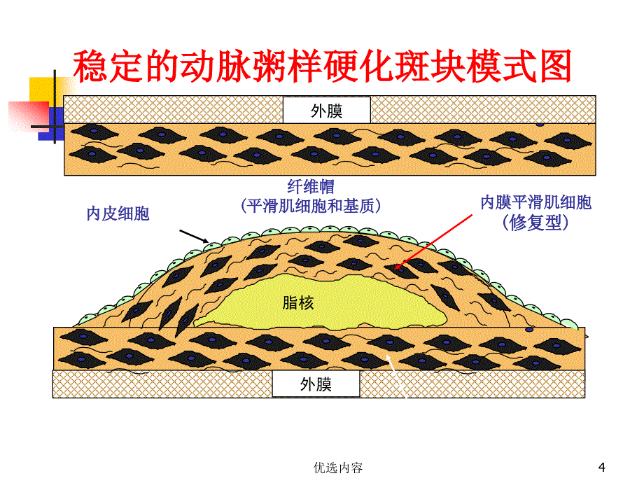 内科学稳定型心绞痛业内荟萃_第4页