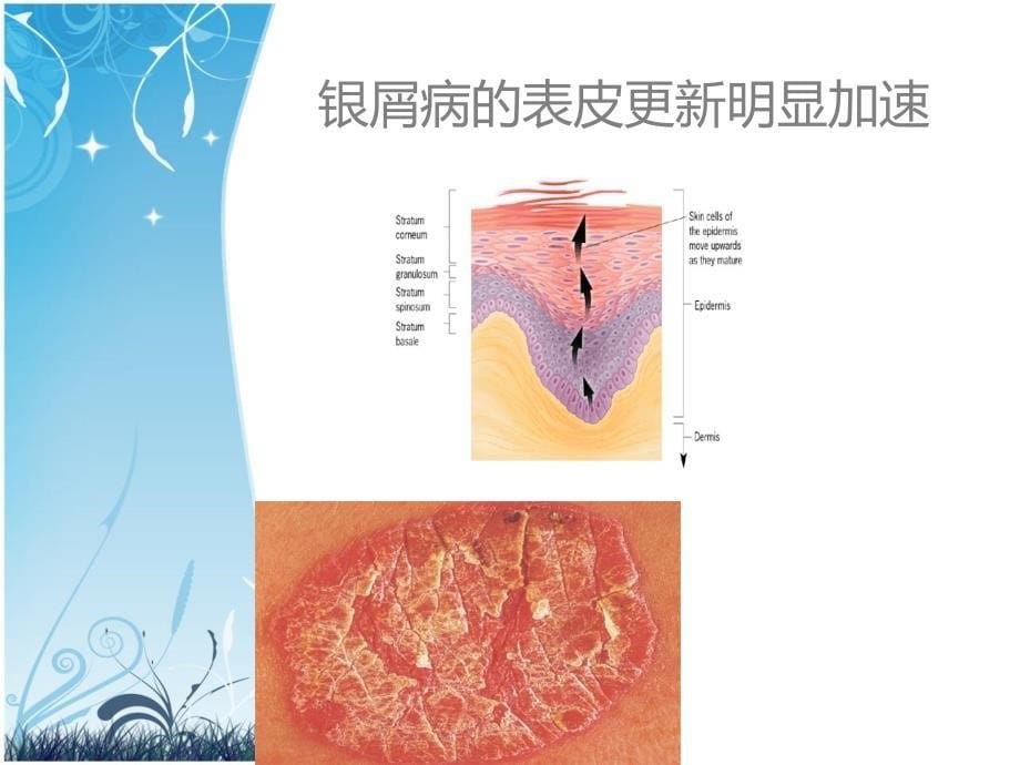 皮肤性病学：银屑病_第5页