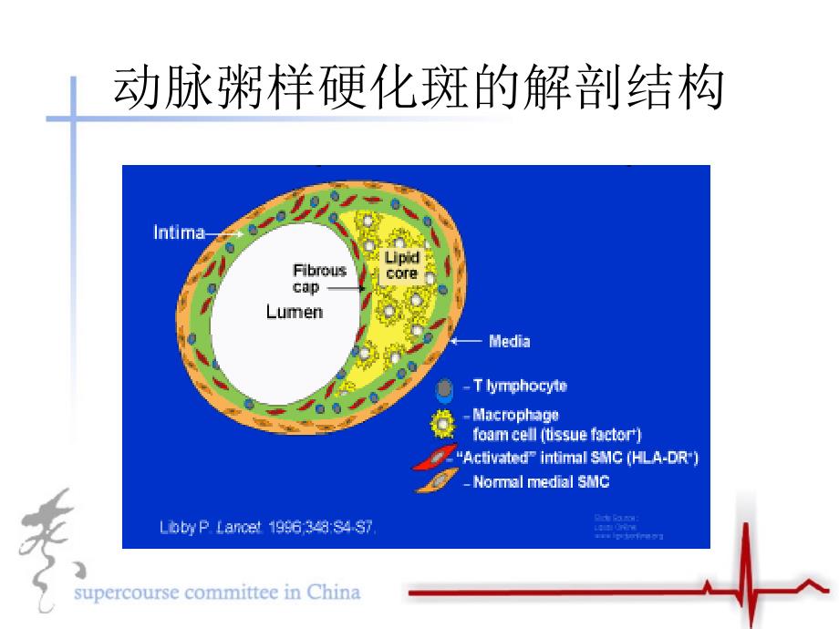 急性冠脉病症的病理机制_第4页