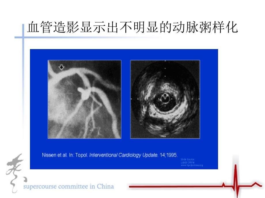 急性冠脉病症的病理机制_第5页