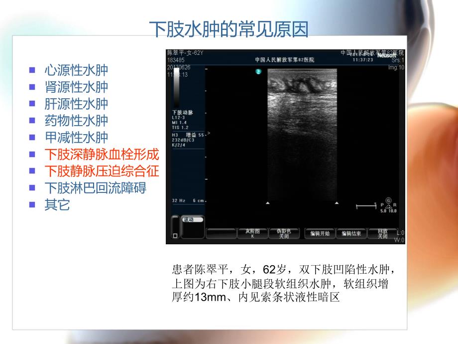 髂动脉瘤致髂静脉受压综合症一例病案讨论课件_第3页