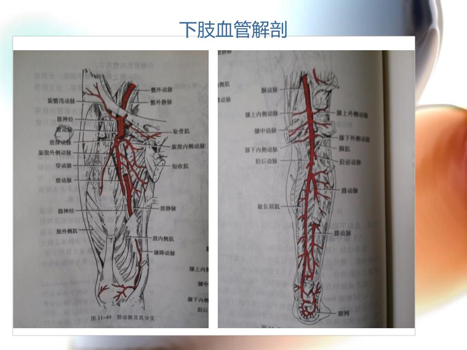 髂动脉瘤致髂静脉受压综合症一例病案讨论课件_第4页