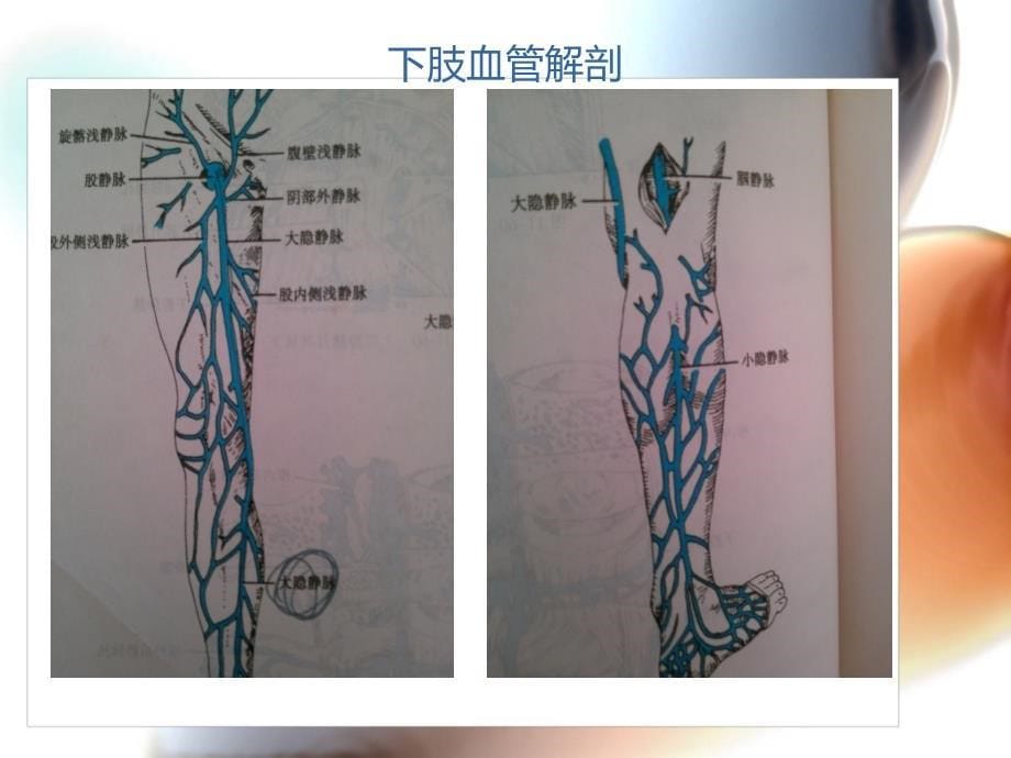 髂动脉瘤致髂静脉受压综合症一例病案讨论课件_第5页