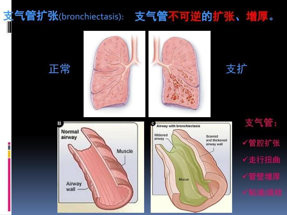 支气管扩张症中西医治疗进展课件_第5页