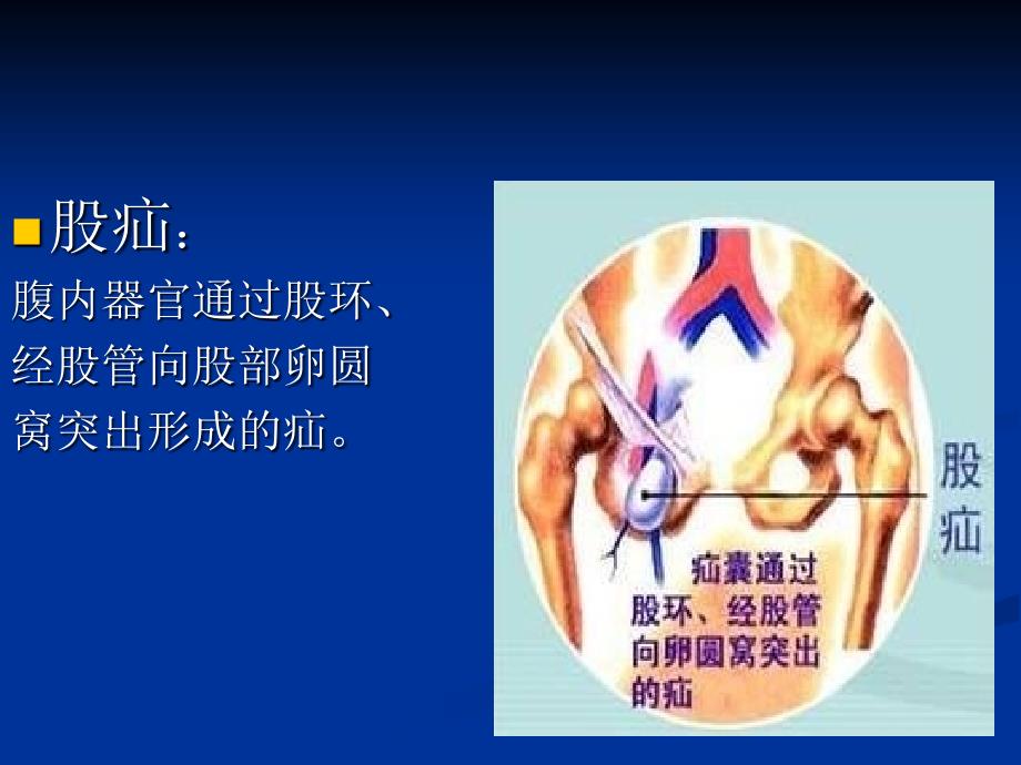 《例股疝高位结扎术》PPT课件.ppt_第4页