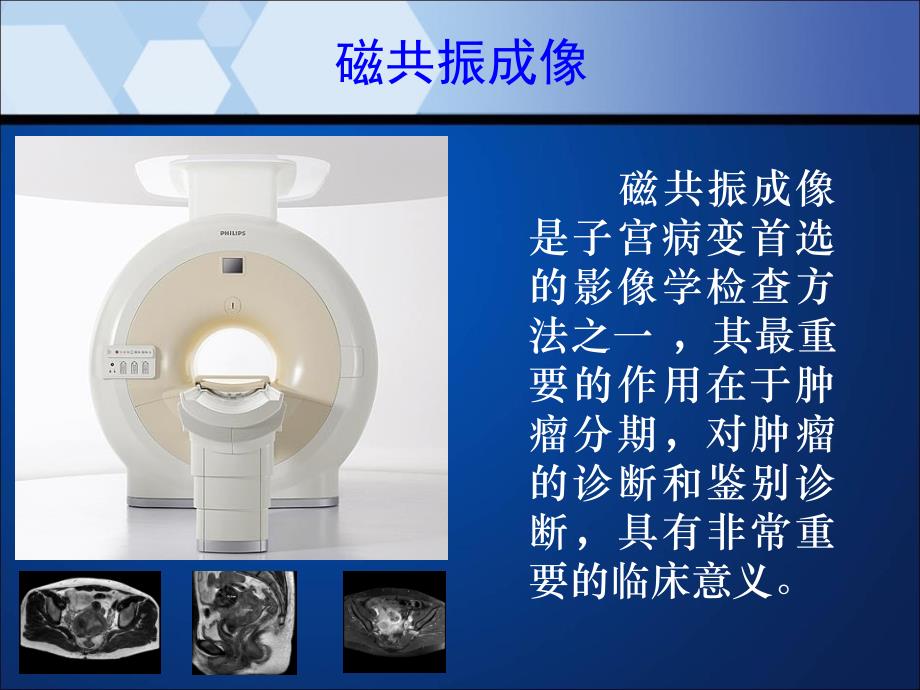 子宫内膜癌MRI影像表现说课讲解_第2页