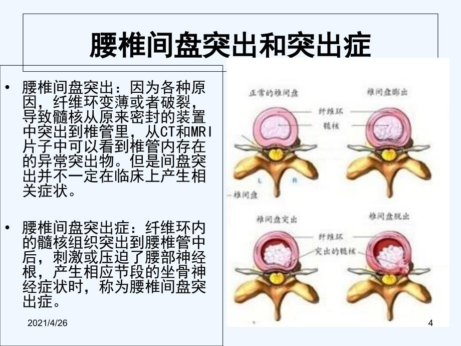 腰椎间盘突出症的康复治疗精品课件_第4页