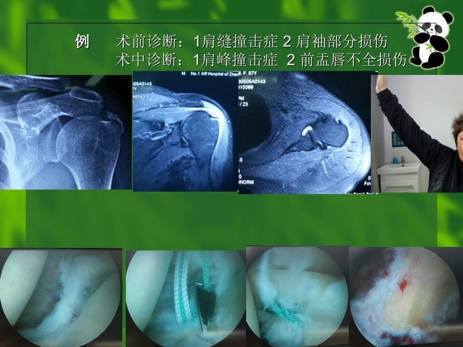 医学肩关节疾病诊疗治疗PPT培训课件_第5页