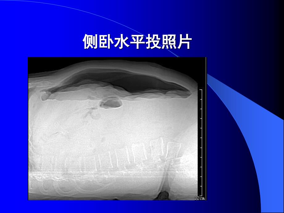 医学影像学：急腹症_第3页