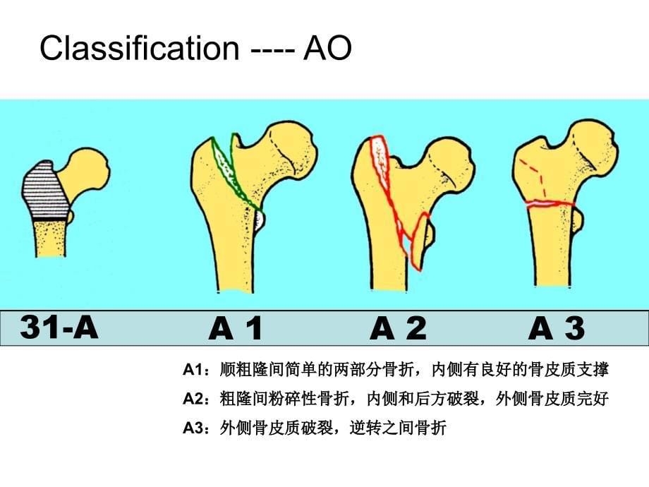 pfna粗隆间骨折治疗ppt课件_第5页