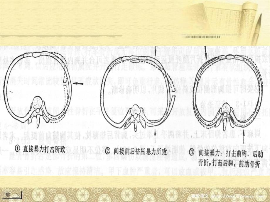 肋骨骨折讲课PPT课件_第4页