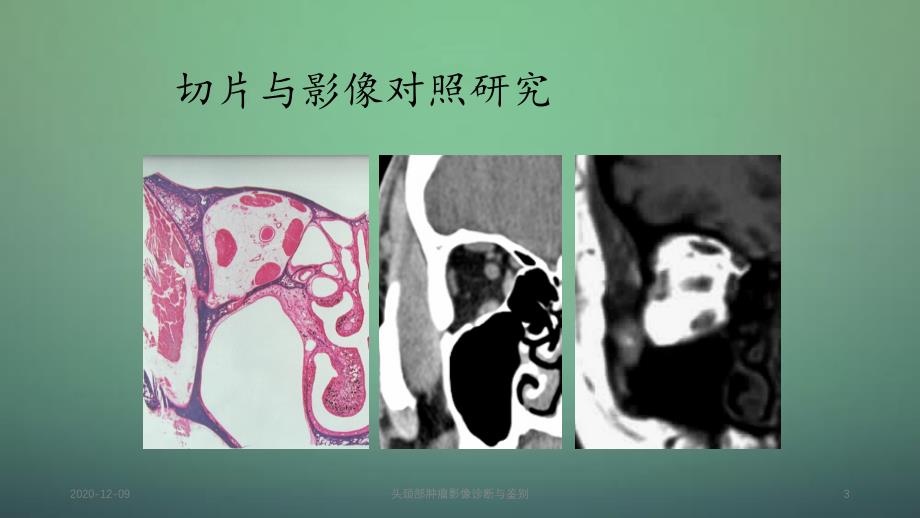 头颈部肿瘤影像诊断与鉴别_第3页