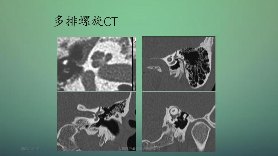 头颈部肿瘤影像诊断与鉴别_第4页