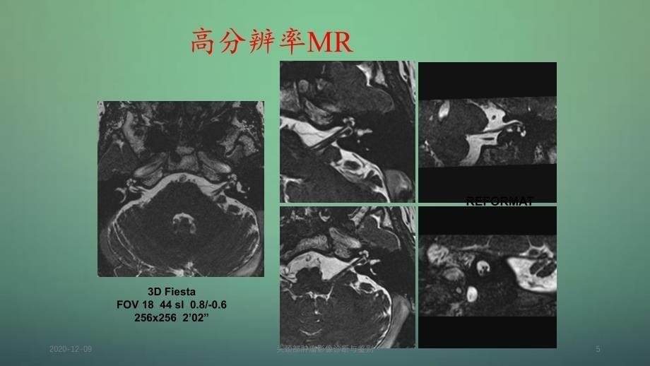 头颈部肿瘤影像诊断与鉴别_第5页