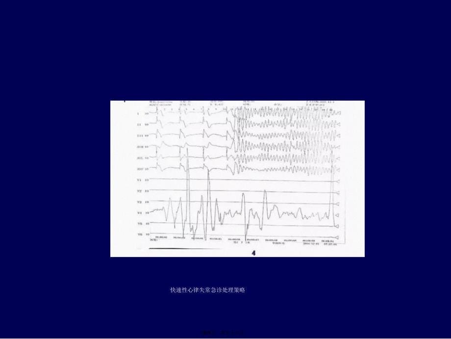 快速性心律失常急诊处理策略课件_第5页
