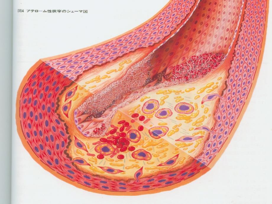 医学专题：冠心病防治_第3页