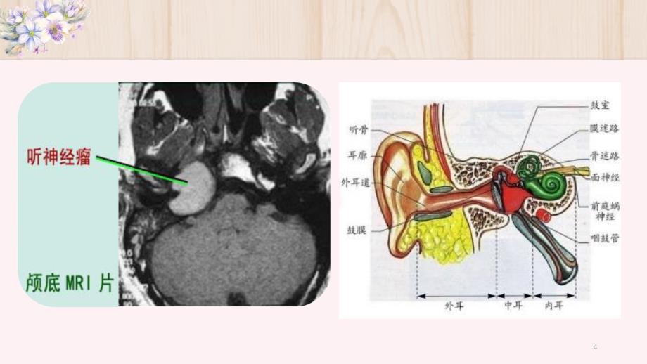 优质课件听神经瘤的护理查房_第4页