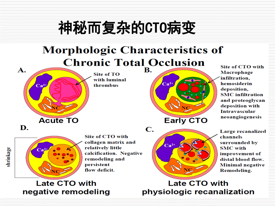 最新在慢完全闭塞介入治疗中我是怎样合理选择器械的课件幻灯片_第2页