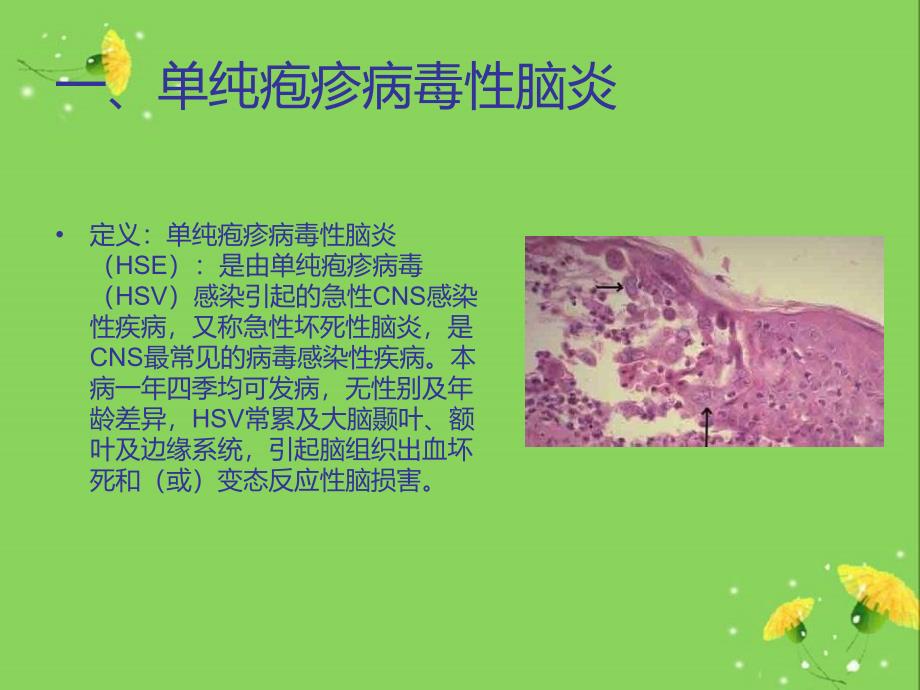 病毒性脑炎PPT通用课件_第4页