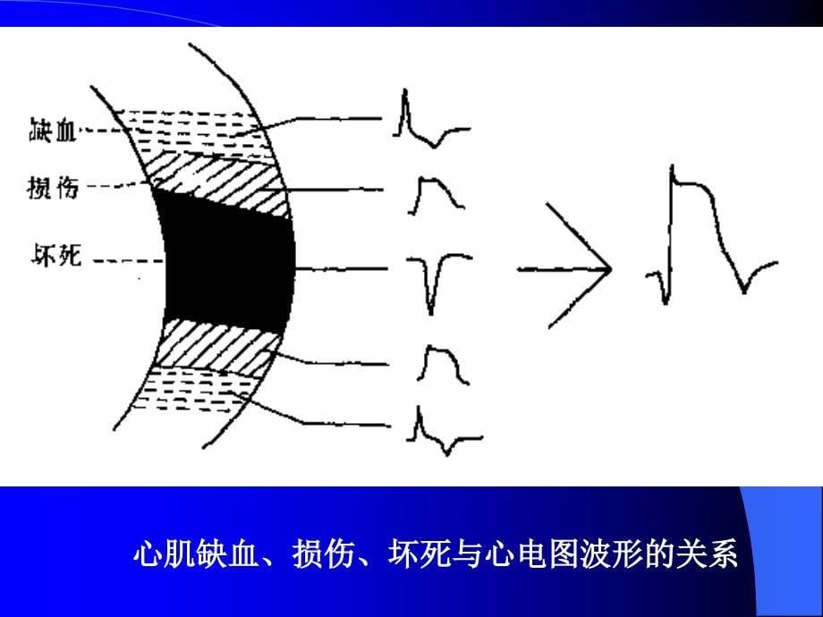 心肌梗死心电图_第5页