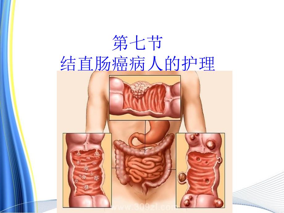 第十五章第七节结直肠癌病人的护理_第3页