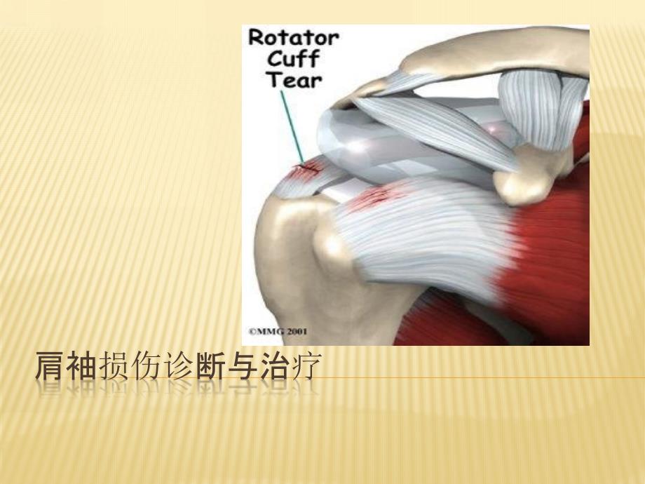 肩袖损伤的治疗_第1页