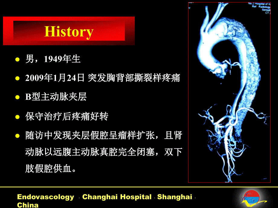 涉及分支动脉的主动脉腔内隔绝移植物系统的研制_第2页