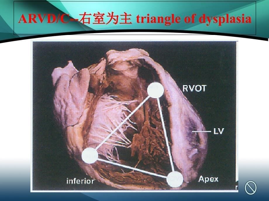 致心律失常性右室心肌病_第5页