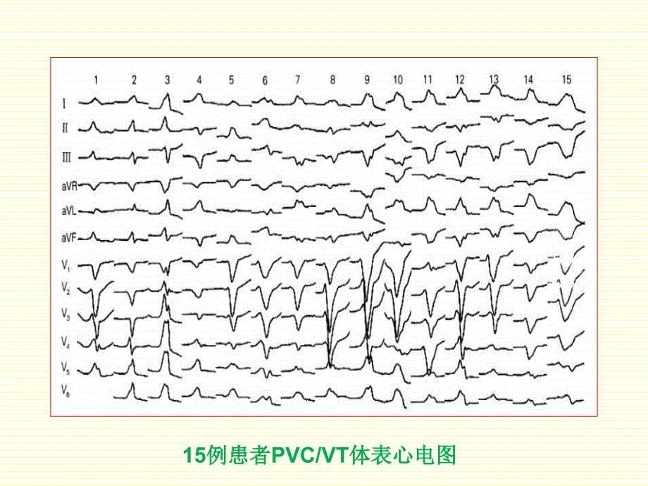 起源于三尖瓣环的室早室速导管消融治疗_第5页