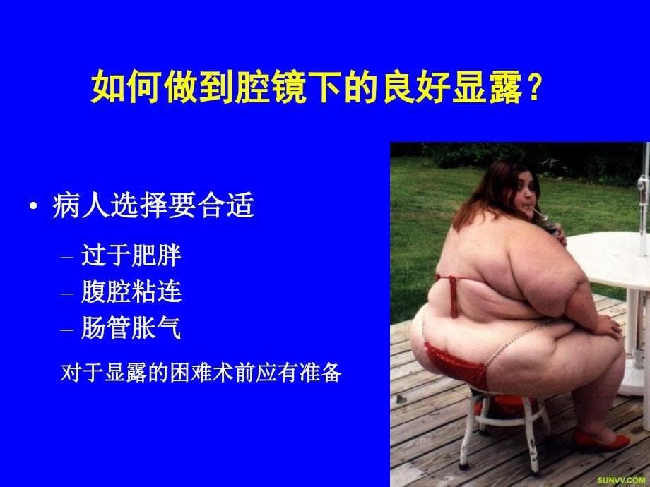 腹腔镜直肠癌手术的扶镜及显露技巧_第5页