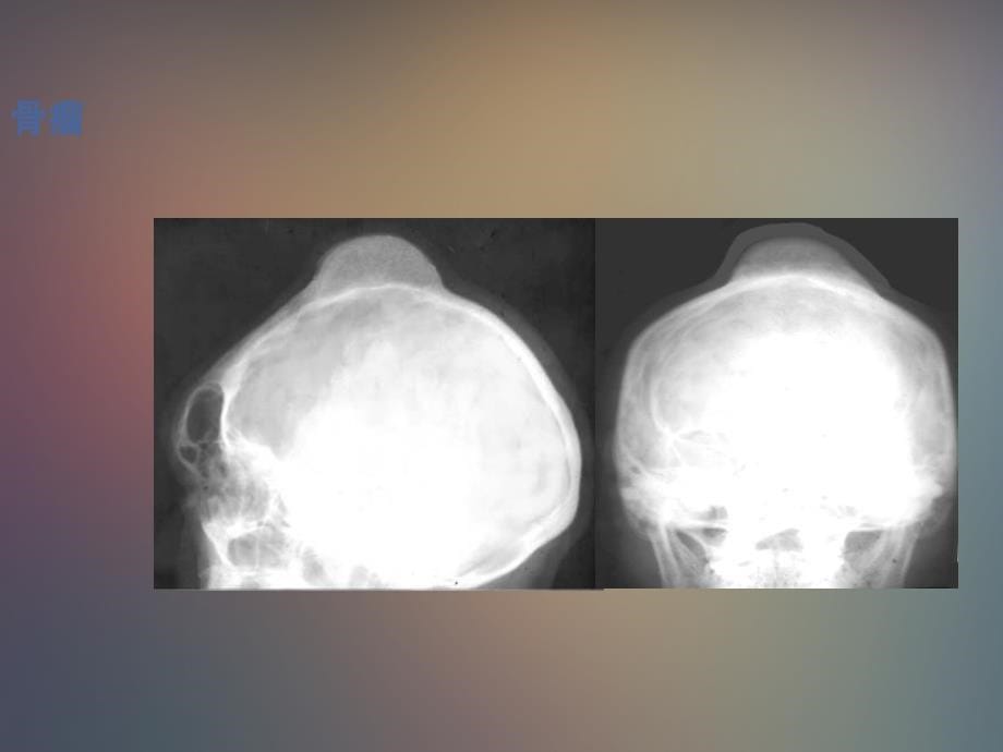良性骨肿瘤诊断 ppt课件_第5页