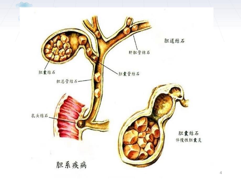 胆道疾病患者的护理课件_第4页