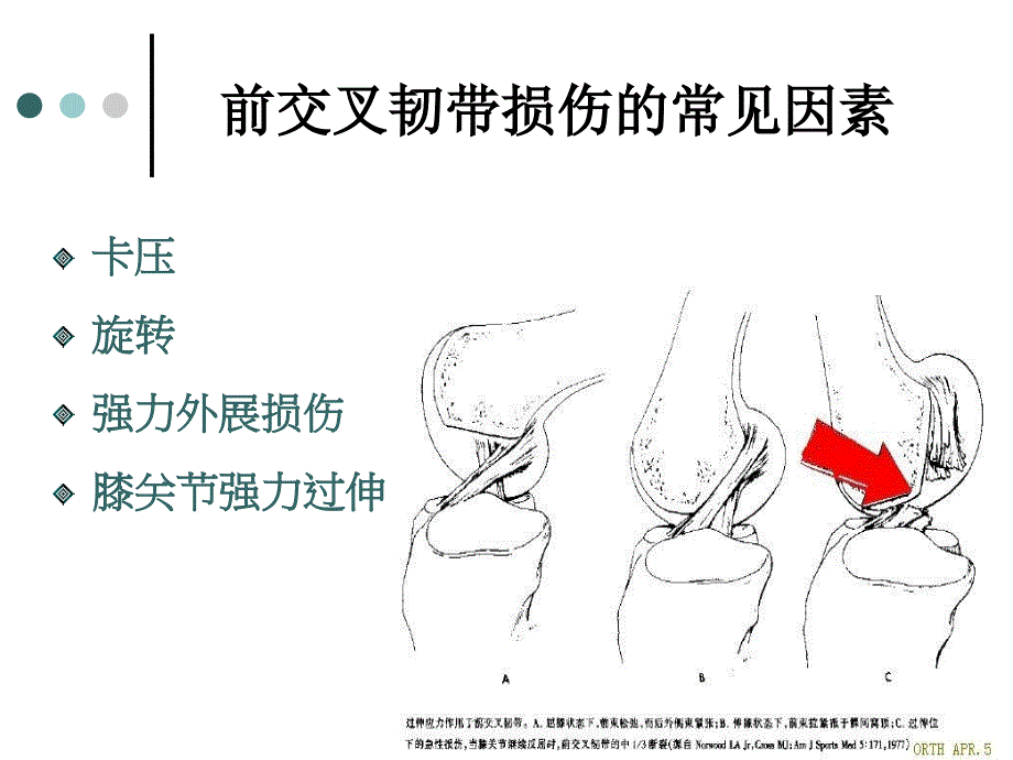 关节镜下前交叉韧带重建手术的配合_第4页