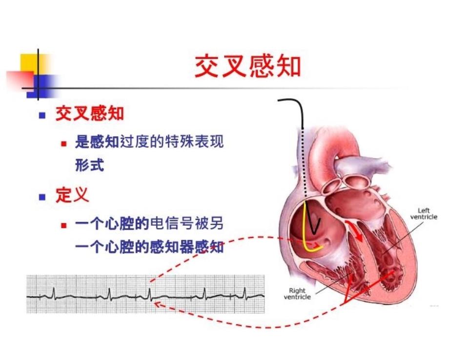 最新复杂疑难起搏心电图阅读技巧幻灯片_第5页