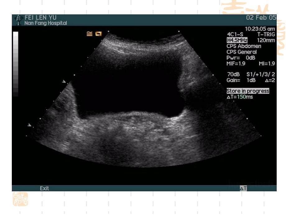 泌尿系统超声诊断_第5页