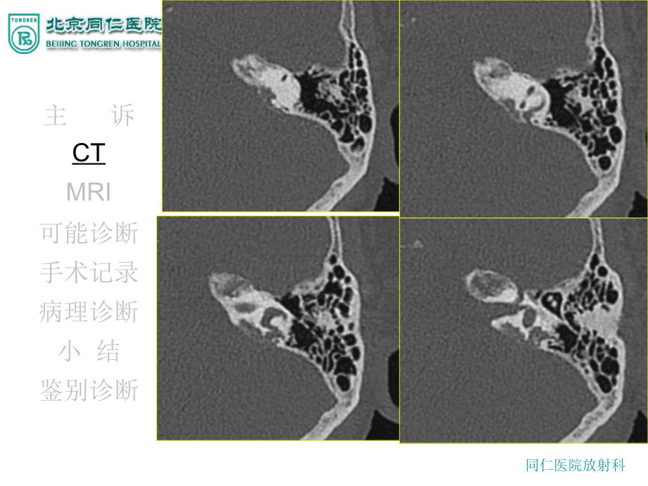 内淋巴囊肿瘤ppt课件_第3页