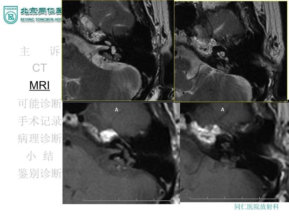 内淋巴囊肿瘤ppt课件_第5页