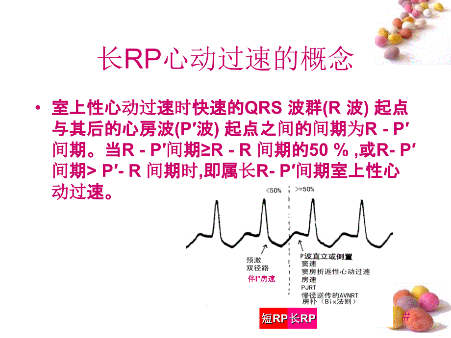 长RP心动过速的图鉴别诊断_第3页