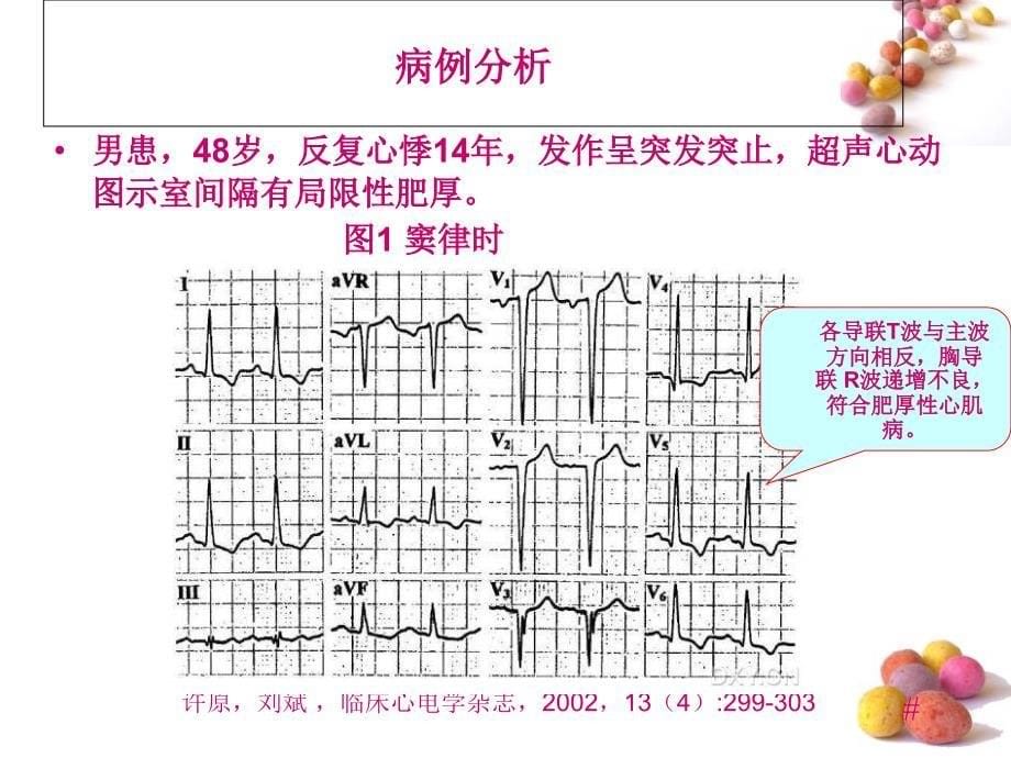 长RP心动过速的图鉴别诊断_第5页