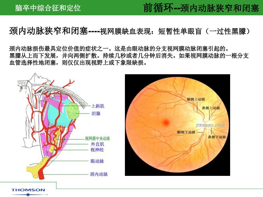 脑卒中综合症和定位课件_第4页