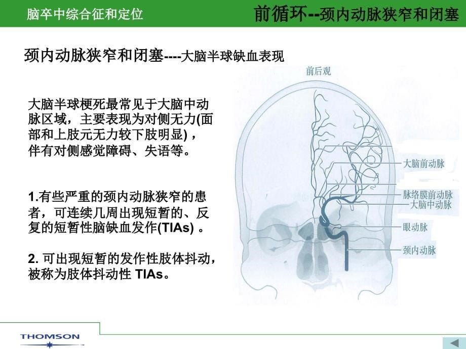 脑卒中综合症和定位课件_第5页