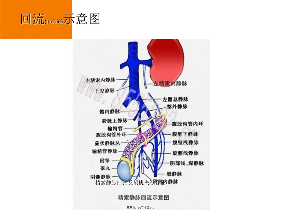 精索静脉曲张及胡桃夹综合征课件_第4页